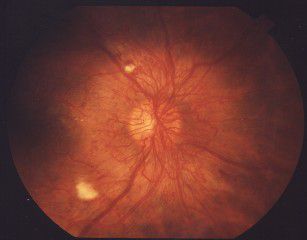 diabētiskās retinopātijas, asinsvadi kļūst, cukura diabēts, cukura līmenis, cukura līmenis asinīs