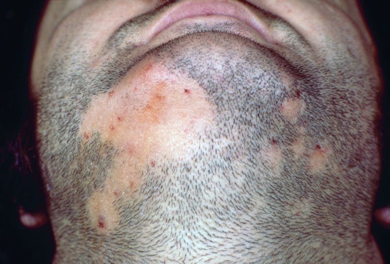 Alopēcija Areatas, matu izkrišanas, daži cilvēki, daži pētījumi, daži pētījumi liecina