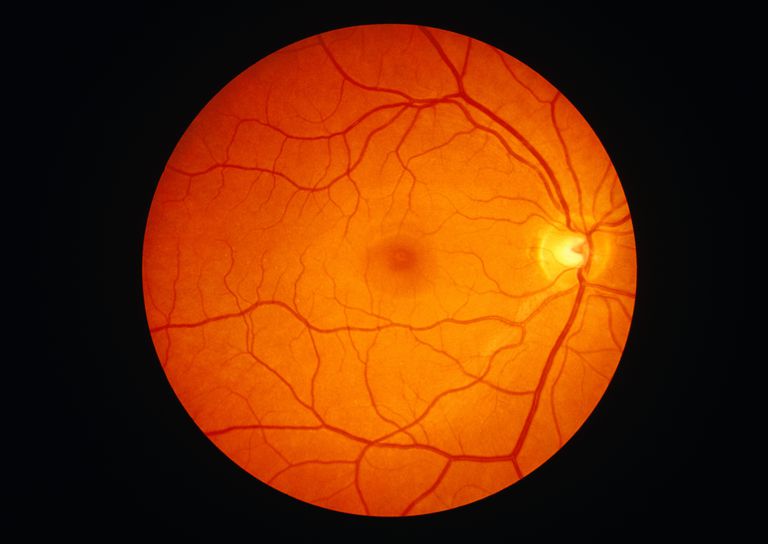 Centrālā serozā, Centrālā serozā retinopātija, Diabētiskā retinopātija, Makaronu deģenerācija, redzes nerva