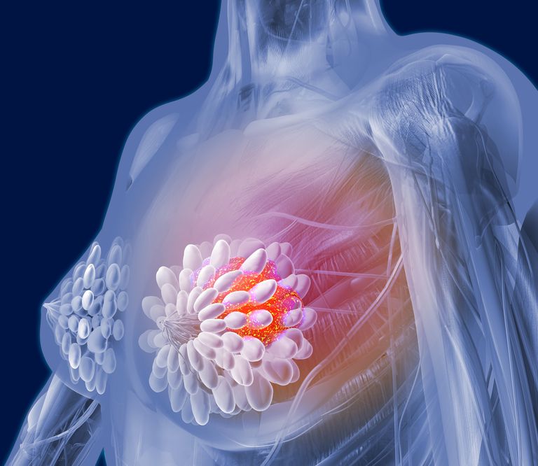 krūts Vēzis, krūts vēža, veida krūts, veida krūts vēzis, Angiosarkomas krūts, angiozarcoma diagnosticēta