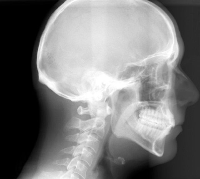 rentgena starojums, cefalometrisko x-ray, Cefalometriskos rentgenstarus, ortodontiskās ārstēšanas, rentgena starojums tiek, starojums tiek