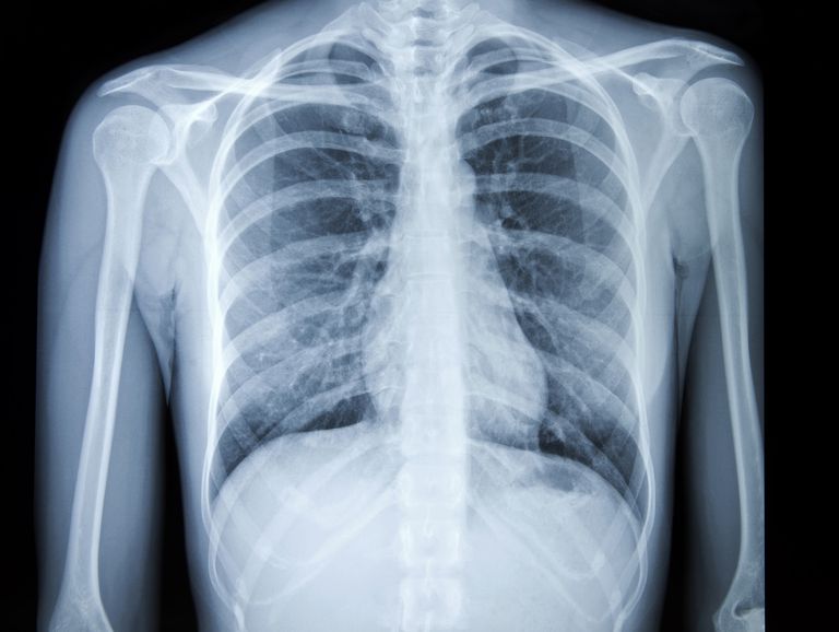 plaušu vēža, plaušu vēzi, krūšu kurvja, krūšu kurvja rentgena, kurvja rentgena