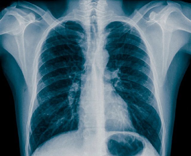Krūškurvja rentgena, krūts rentgena, krūšu kurvja, krūšu kurvja rentgenogrāfija, kurvja rentgenogrāfija, rentgena staru