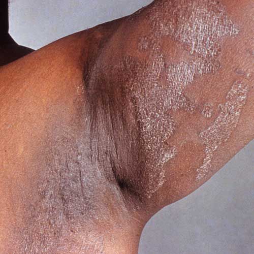 Staphylococcus aureus, ādas infekcija, ādas infekcijas, ādas slāņus, attīstās vietās