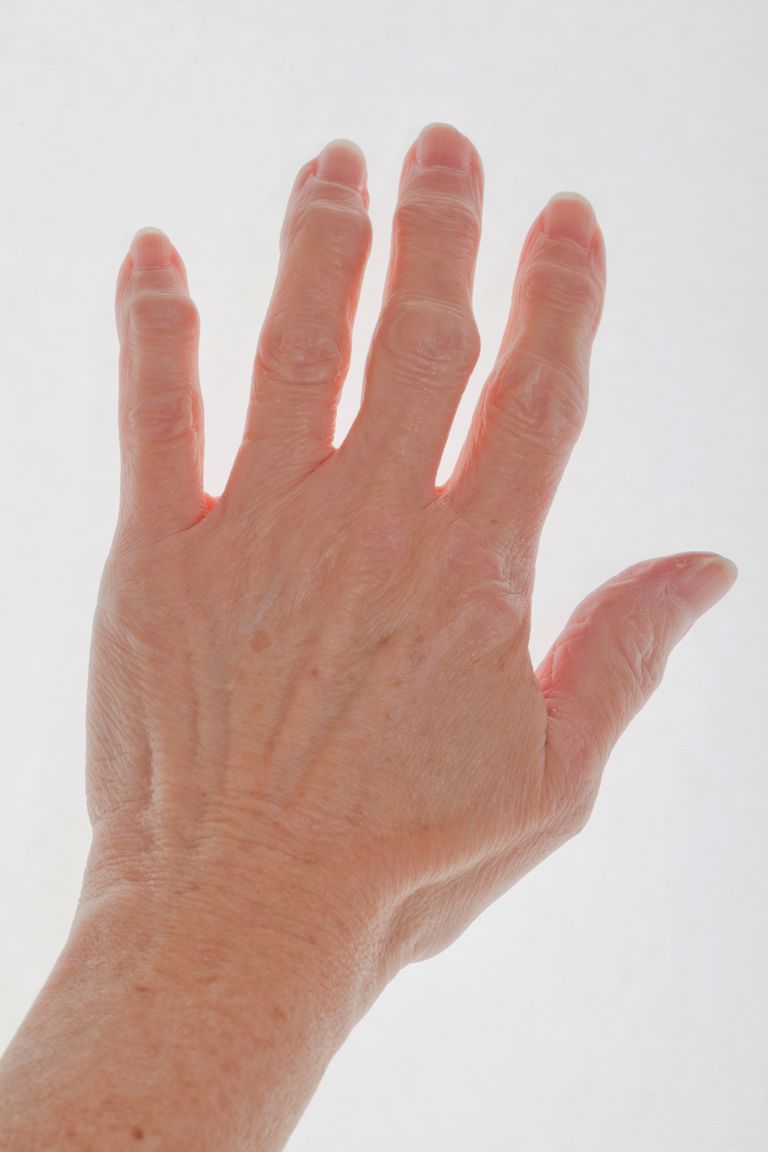pirkstu locītavu, kaulu spuras, cilvēku pirkstu, cilvēku pirkstu artrītu, jūsu ķermeņa, locītavām Visbiežāk