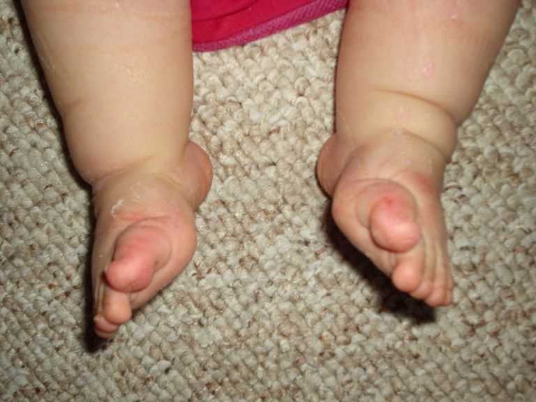 abās kājās, bieži vien, Jūsu mazuļa, jūsu mazulim, mazuļa kājas