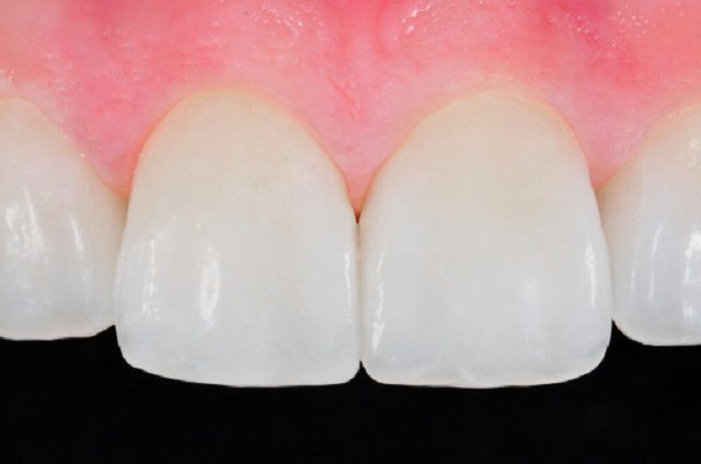 jūsu zobiem, Jūsu zobārsts, ādas toni, dabiskajiem zobiem
