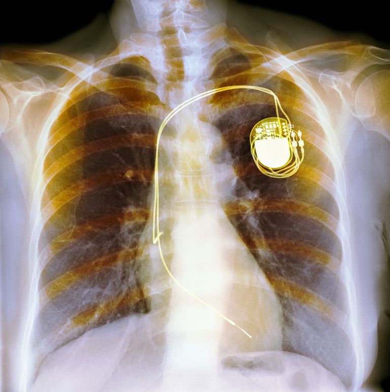 Elektrokardiostimulatoru ģeneratoru, JAMA 2006, ķirurģiskas komplikācijas, neatbilstošus satricinājumus, nekā sākotnējā, nekā sākotnējā operācija