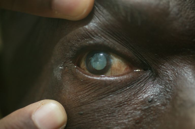 risku attīstīt, subkapsulu kataraktu, 10-14 dienas, 10-14 dienas vairāk, acis rezultātā, acis rezultātā ārsti