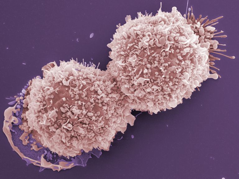 krūts vēža, krūts Vēzis, piena kanālos, jūsu piena, krūts vēža veids, vēža forma