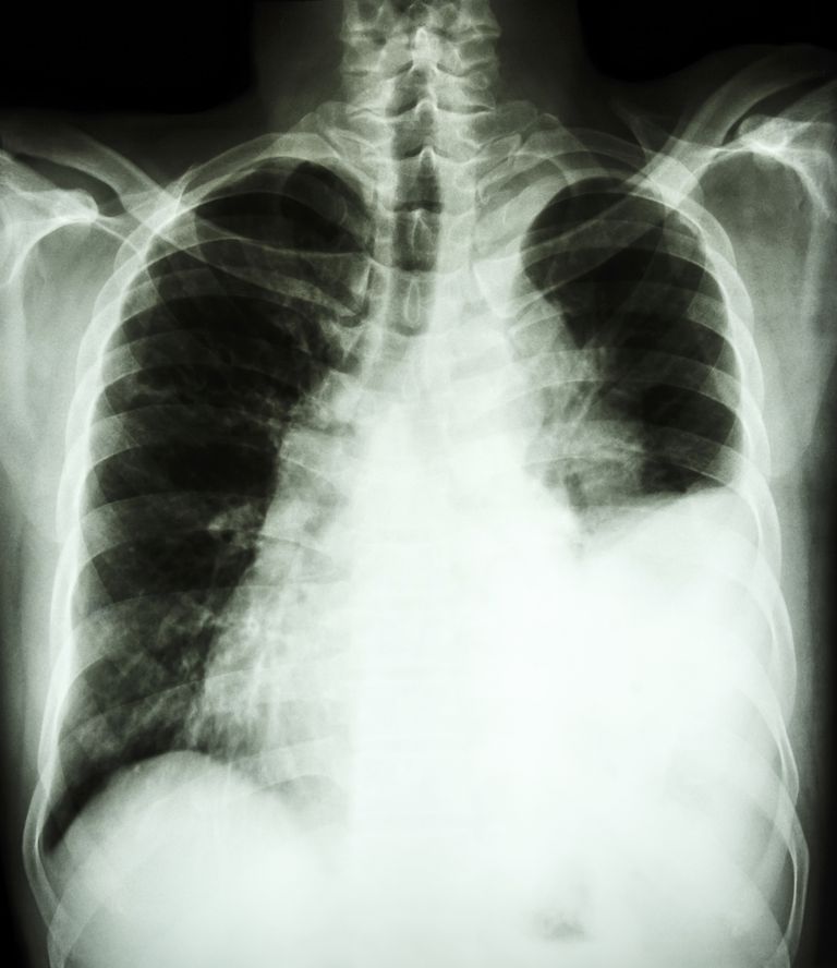 plaušu vēzi, cilvēku plaušu, cilvēku plaušu vēzi, vēža slimniekiem, ārkārtas situācija