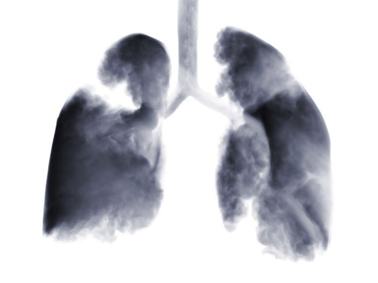 plaušu vēža, plaušu vēzis, plaušu vēzi, nesīkšūnu plaušu vēža, sīkšūnu plaušu