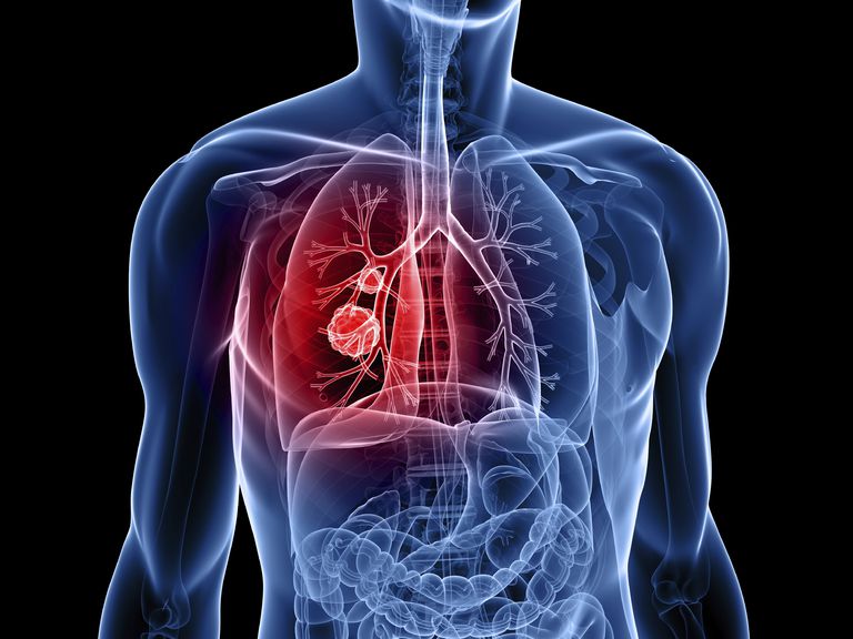 plaušu vēzi, plaušu vēža, plaušu vēzis, nesīkšūnu plaušu vēža
