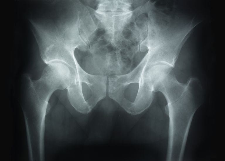 izraisa osteonekrozi, osteonekroze attīstās, osteonekrozi Tomēr, parasti tiek