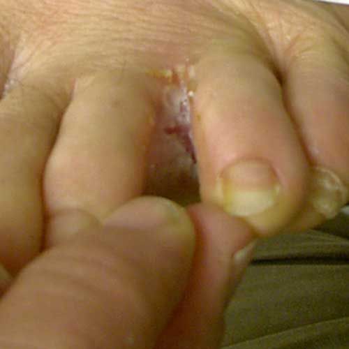 sportista kājiņa, starp pirkstiem, herpes simplex, impetigo forma, nagu infekcija