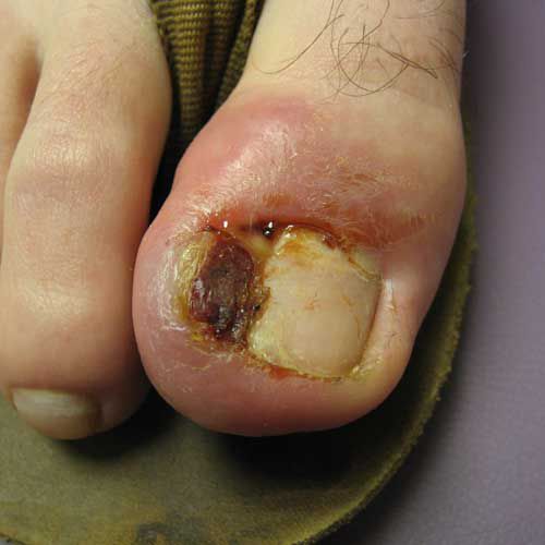 sportista kājiņa, starp pirkstiem, herpes simplex, impetigo forma, nagu infekcija
