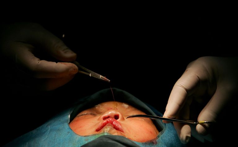 Kosmētiskā ķirurģija, ietver sekojošo, ietver sekojošo krūšu, ķirurģija vērsta, ķirurģiskās procedūras