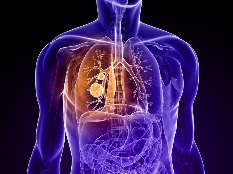 plaušu masu, plaušu masas, plaušu vēzi, plaušu masa, plaušu vēža