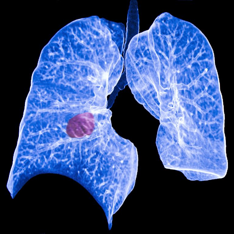 plaušu vēzis, plaušu vēzi, primārais plaušu vēzis, plaušu vēža