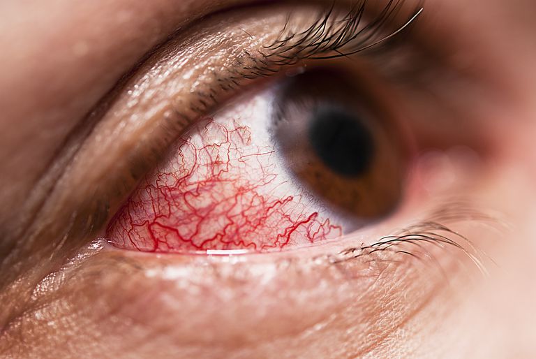 bieži vien, bieži vien saistīts, redzes zudumu, Scleromalacia perforans