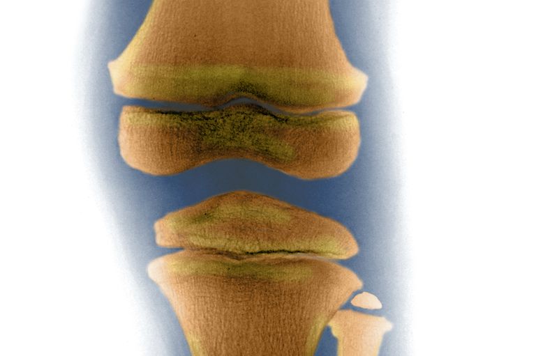 osteoartrīta gadījumā, nozīme osteoartrīta, Subchondral Bone, subhondrālas kaulu, subhondrālo kaulu, tiek novērots