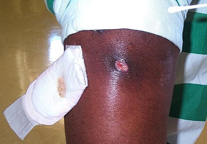 MRSA infekcijas, Staphylococcus aureus, aureus MRSA, staphylococcus aureus MRSA, ādas infekcijas