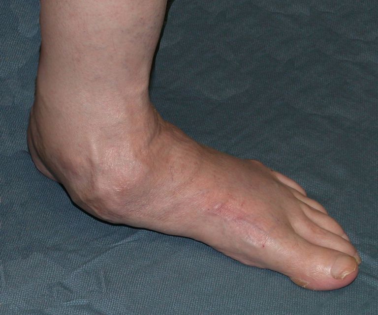 plakana pēda, plakanas kājas, plakano pēdu, plakanu pēdu, dažāda veida, pēda ķirurģija