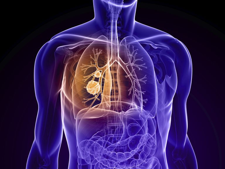 plaušu vēzis, plaušu vēzi, pakāpes plaušu, pakāpes plaušu vēzi, plaušu vēža