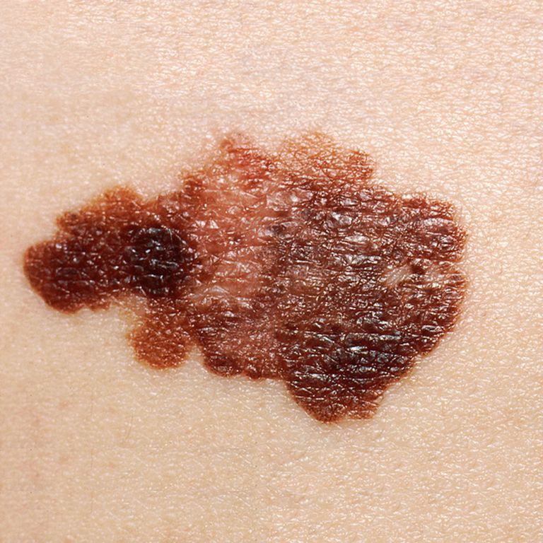 Ādas vēzis, ādas vēzi, ādas vēža, bieži vien, ādas bojājumā