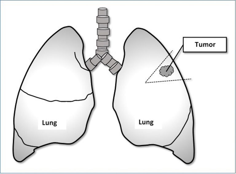 plaušu vēža, ķīļa rezekcija, plaušu vēzi, tiek veikta