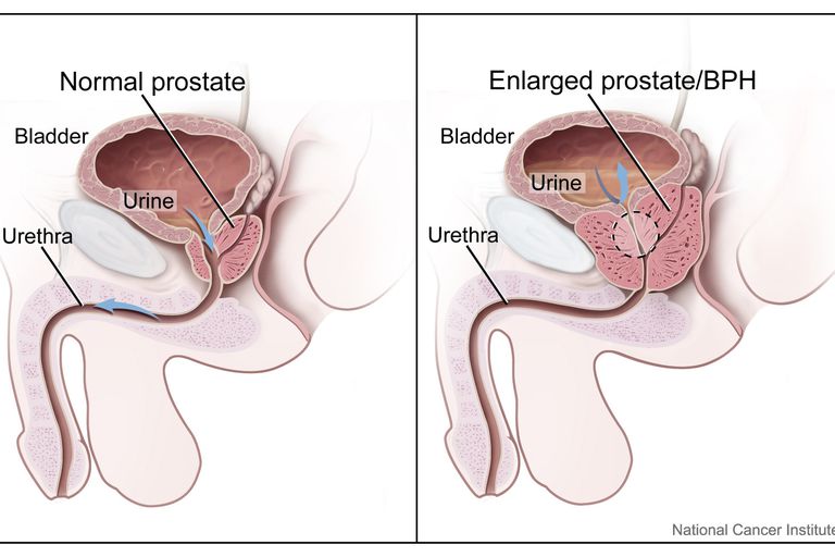 prostatas vēzis, prostatas vēža, krūts vēža, prostatas vēža risks, vēža risks