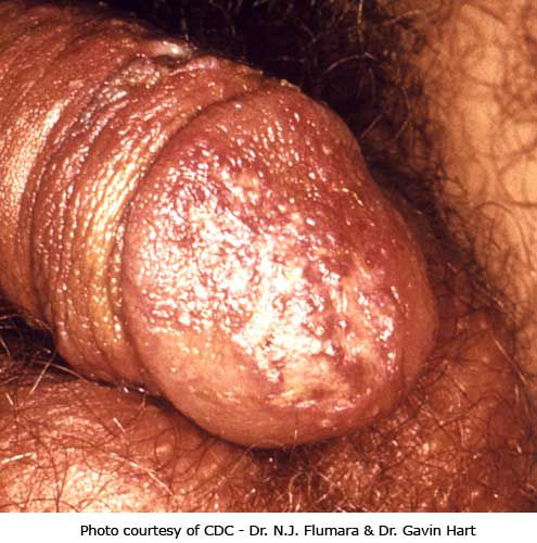 dzimumorgānu herpes, herpes infekcija, herpes simplex, Šajā attēlā, herpes infekciju, herpes uzliesmojums