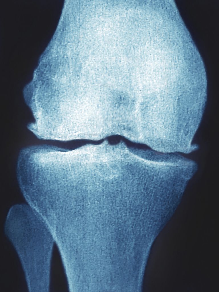 Osteofītu veidošanās, izraisīt sāpes, osteofītu veidošanos, pretsāpju līdzekļus, tiek uzskatīti