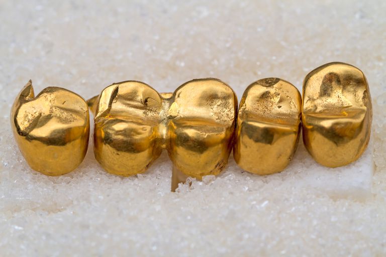 izgatavots zelta, zelta vainagi, zelta vainagu, cēlmetāla sakausējums, izmanto zobārstniecībā