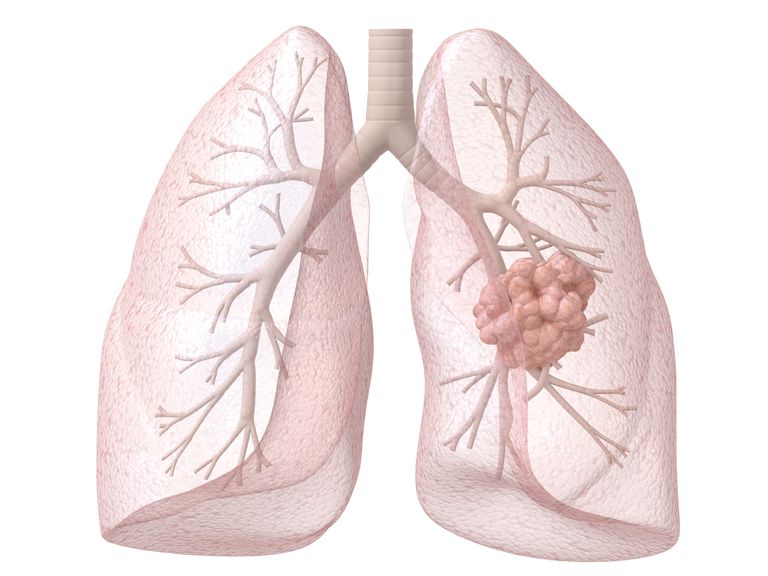plaušu vēža, plaušu vēzi, plaušu vēzis, Amerikas Savienotajās