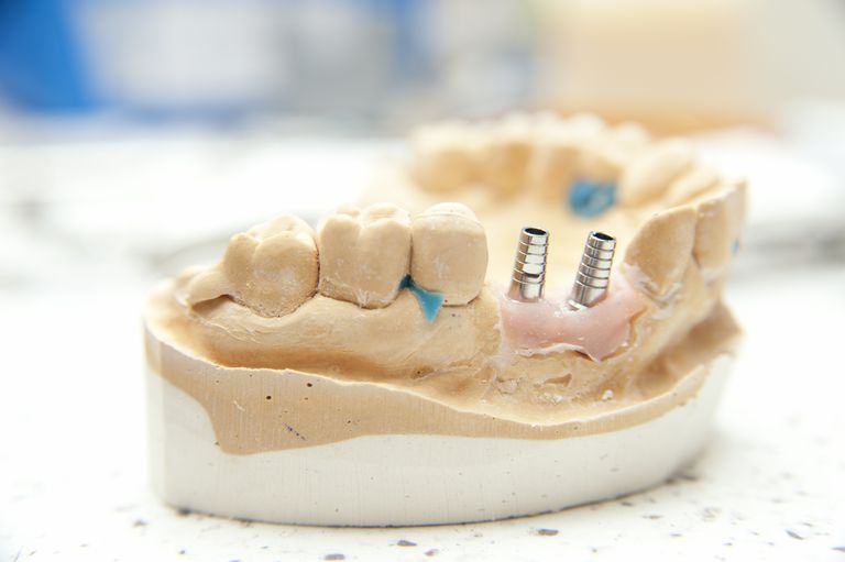mutes dobuma, zobārstniecības procedūras, Zobu implanti