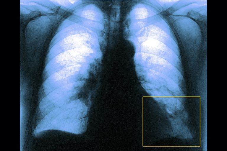 dažās plaušu, kapilāri nesakrīt, mirušā telpa, skābekļa oglekļa, vārdiem sakot, alveolas kapilāri