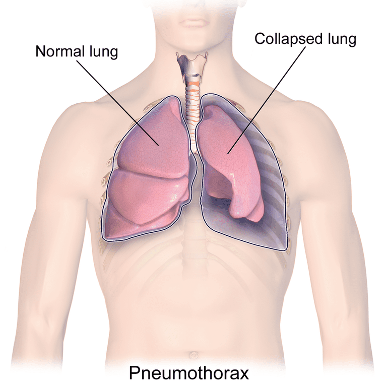 elpas trūkumu, pirms operācijas, skenēšanu plaušu, tiek veikta