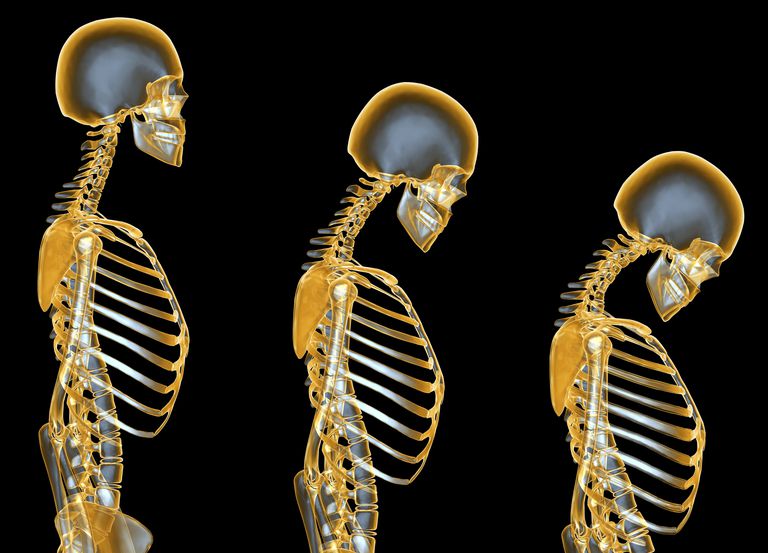 kaulu zudumu, agrīnu kaulu, izraisītas osteoporozes, izraisītu osteoporozi, steroīdu izraisītu