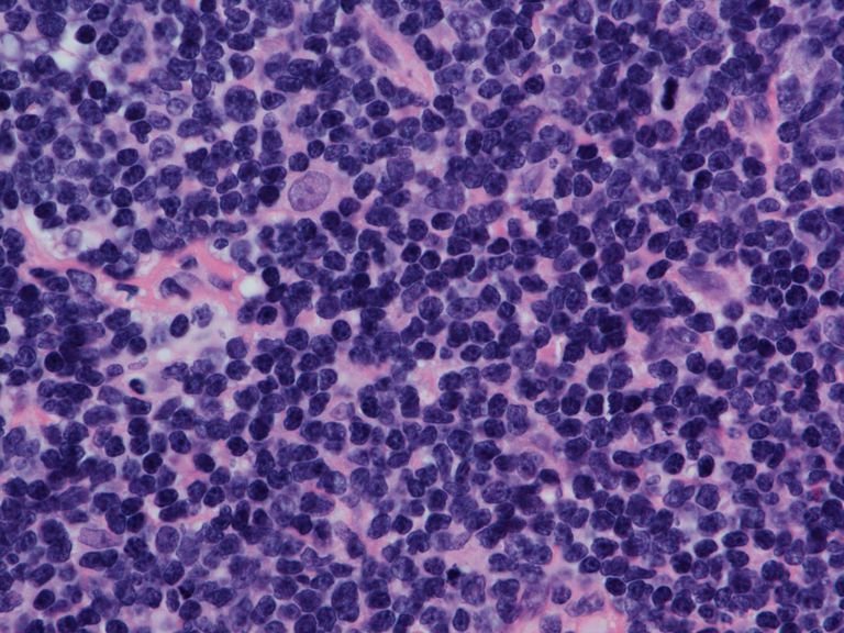 šūnu limfomas, mantijas šūnu, folikulu mantojuma, izveidotu antivielas, limfomas apvalks