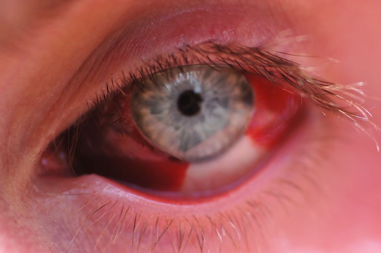 subkonjunktivāla asiņošana, asiņošana parasti, balta daļa, jūsu acis, sarkano asiņu, Subkonjunktivitātes asiņošana