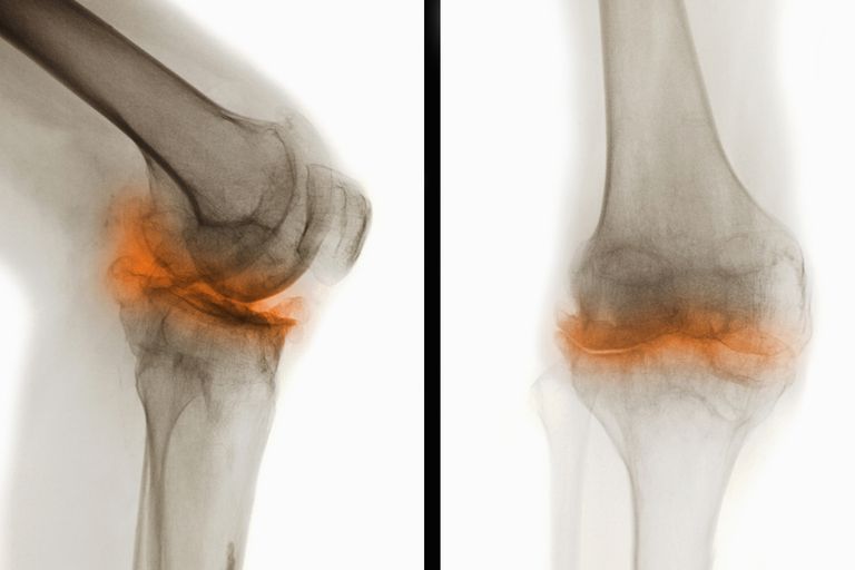 rentgena staros, pierādījumi osteoartrītu